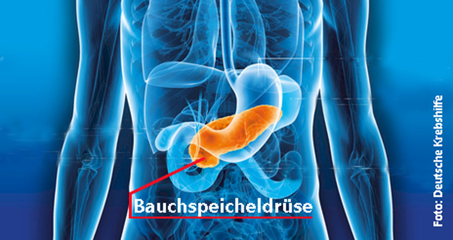 Bauchspeicheldrüsenkrebs - gefährlich, aber behandelbar